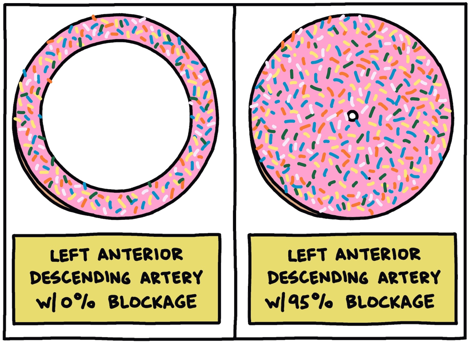 drawing of arteries as donuts, one with 0 percent blockage, one with 95 percent blockage