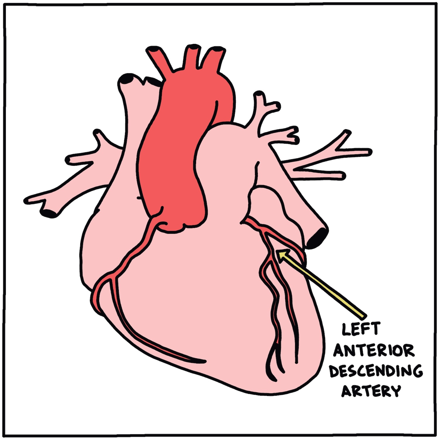 drawing of location of Left Anterior Descending Artery